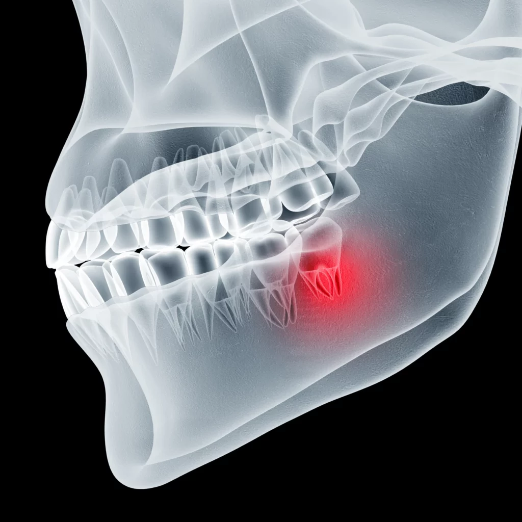 wisdom teeth removal in Sun Prairie, WI