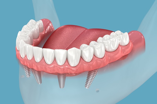 Benefits Of Dentures With All On   Implants