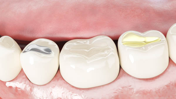 Three Questions To Ask Your Dentist About White Dental Fillings