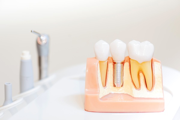 The Different Types Of Dental Implant Restorations
