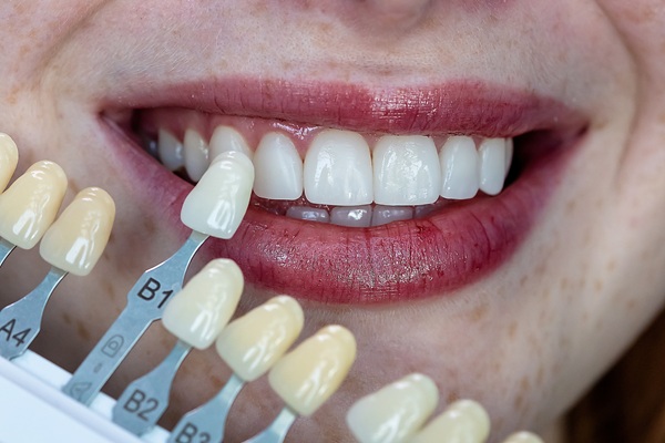 How To Protect The Longevity Of Your New Dental Veneers