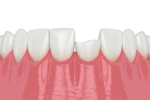 FAQs About Cosmetic Dentistry For Chipped Teeth