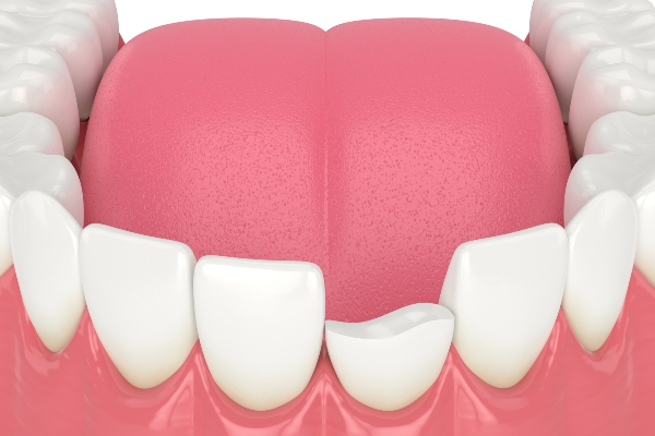 How A Cosmetic Dentist Can Fix Your Chipped Or Cracked Teeth